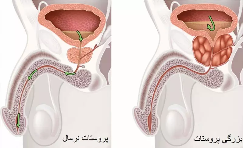 بزرگ شدن پروستات