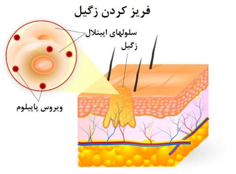 بهترین درمان زگیل تناسلی چیست؟