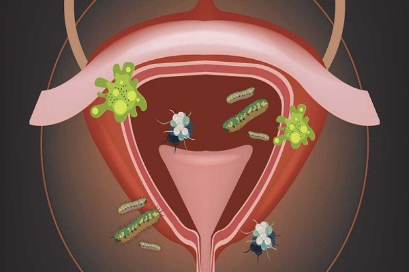 دلایل ایجاد عفونت دستگاه ادراری  (UTI)