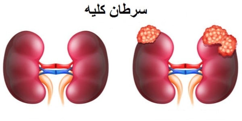 سرطان کلیه باعث درد کلیه سمت راست