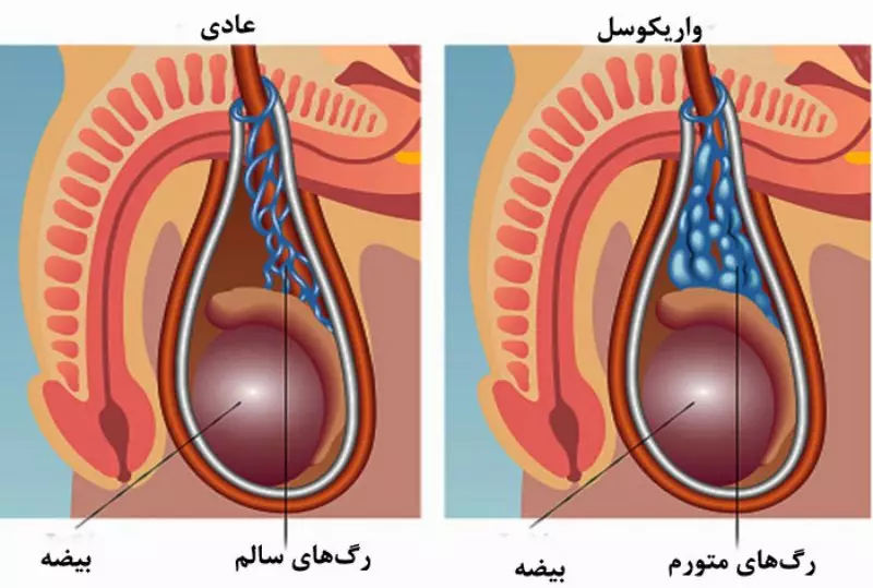 درد واریکوسل چگونه است؟