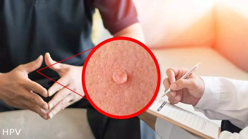 بهترین دکتر زگیل تناسلی