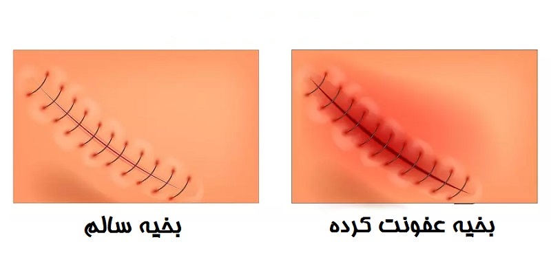 چگونه از جای بخیه جراحی میکروسرجیکال واریکوسل مراقبت کنم؟