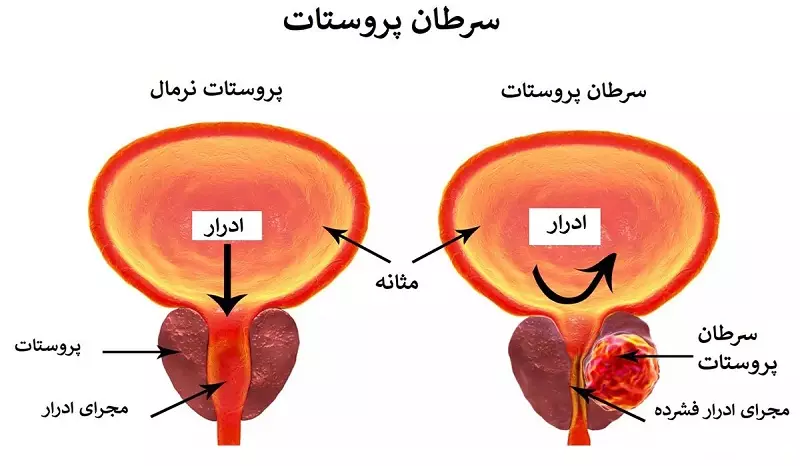 آیا فقط هایپرپلازی خوشخیم پروستات باعث اختلال ادراری است؟