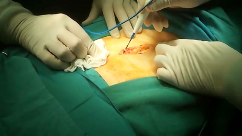 عمل جراحی پروستات باز (پروستاتکتومی)