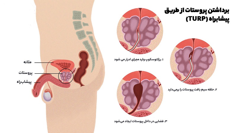درمان قطعی بزرگی خوش خیم پروستات با برداشتن پروستات از طریق پیشابراه (TURP)