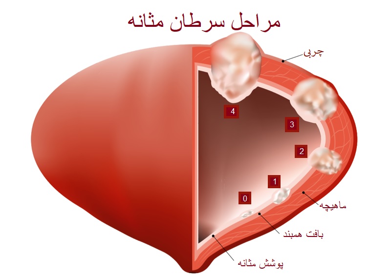 مراحل سرطان بدخیم مثانه