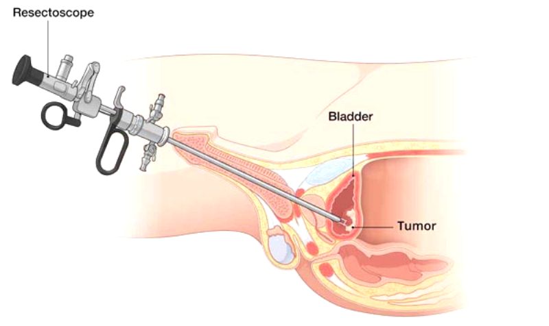 جراحی بدخیم مثانه با برداشت تومور مثانه از راه مجرای ادرار (TURBT)