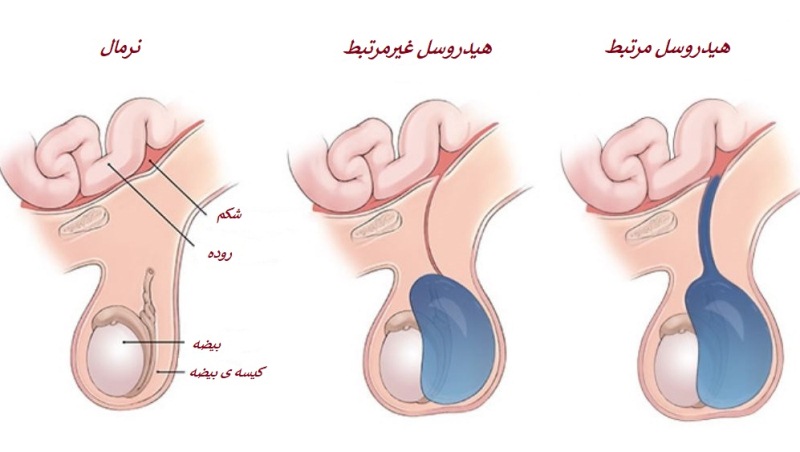 انواع هیدروسل کدامند؟