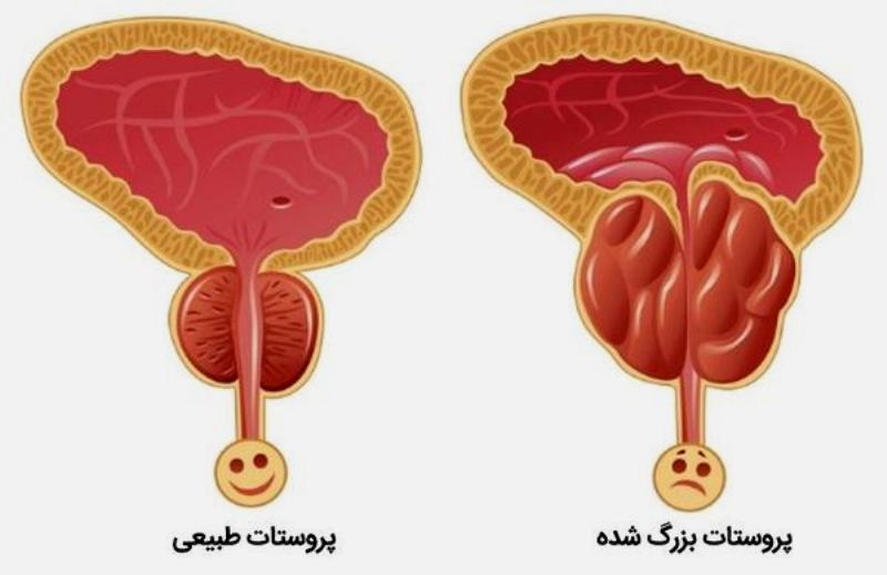 5 نوع جراحی پروستات