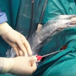 جراحی آندوسکوپیک سنگ کلیه از طریق مجرای ادرار