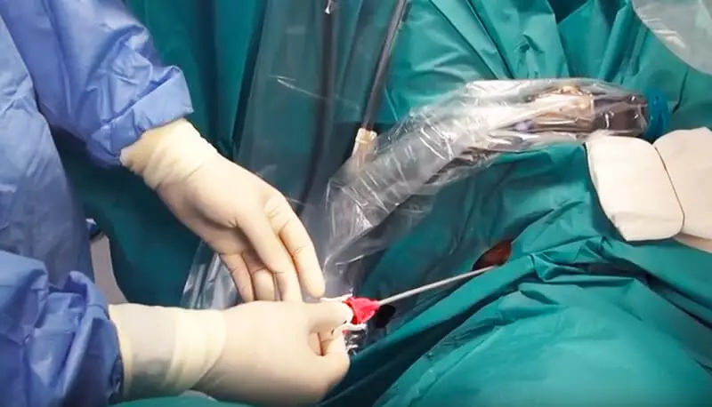جراحی آندوسکوپیک سنگ کلیه از طریق مجرای ادرار
