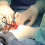 عمل جراحی سنگ کلیه به صورت باز