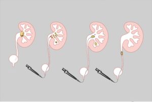 جراحی سنگ کلیه به روش لیزر