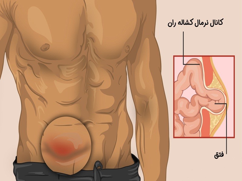 علایم فتق کشاله ی ران