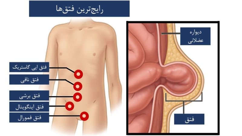 انواع فتق 