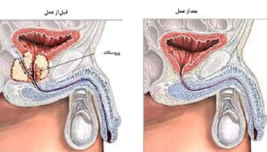 جراحی پروستات به روش عمل باز (عوارض + مراقبت ها)