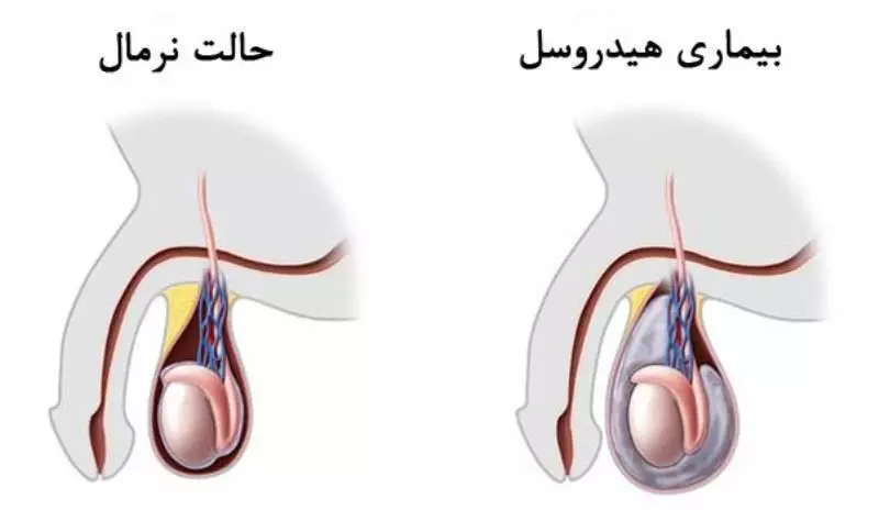 آیا جراحی واریکوسل خطرناک است؟ عوارض جراحی واریکوسل